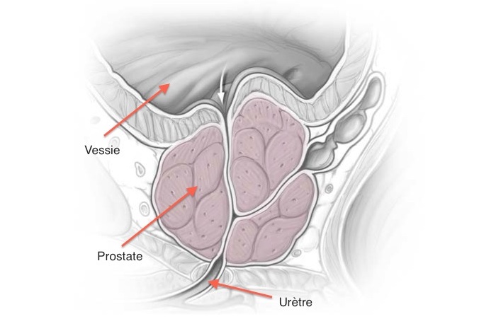 cancer prostate jeune symptômes